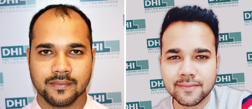 DHI before & after hair transplant results